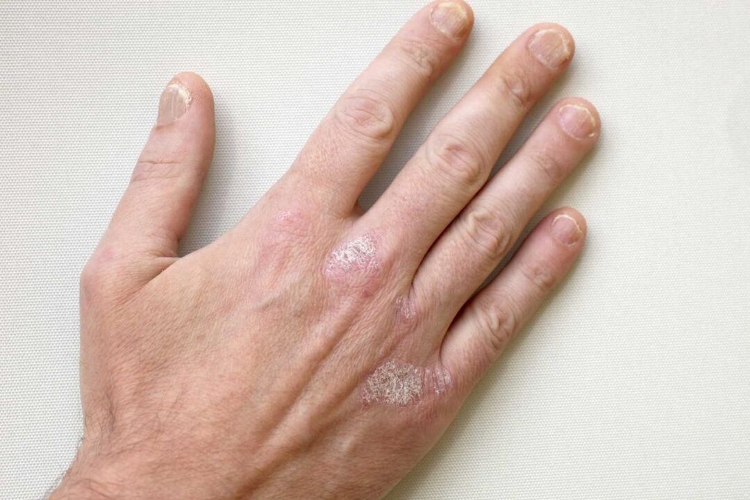 Psoriasis an den Händen eines Mannes, der mit Keramin-Creme behandelt wurde