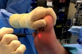 Chirurgische Methoden zur Beseitigung von Warzen