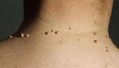 Die Gründe für das Auftreten von Papillomen im menschlichen Körper