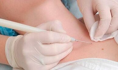 Papillome Elimination -Methoden am Hals