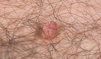 Möglichkeiten zum Übertragen von menschlichem Papillomavirus