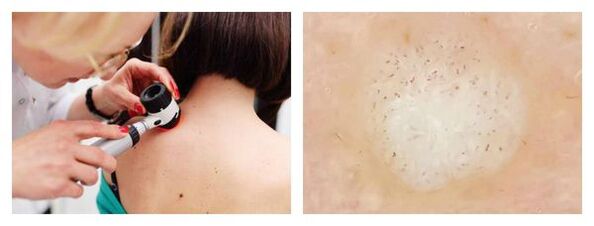 Dermatoskopie der Warze