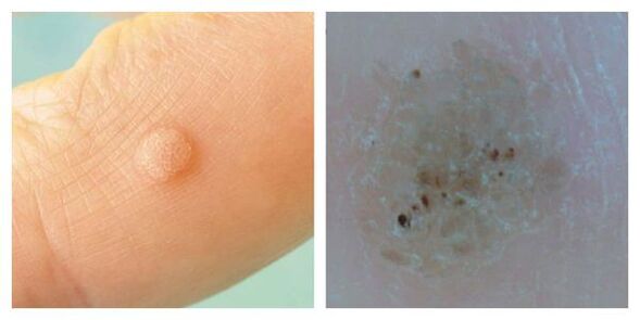 Gewöhnliche Warzen während der Untersuchung und Dermatoskopie