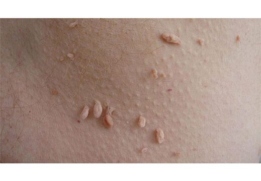Ein Zeichen einer HPV-Infektion ist das Auftreten von Papillomen am Körper. 
