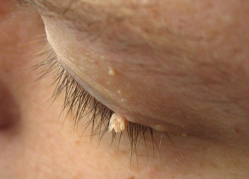 Warzen vor unseren Augen